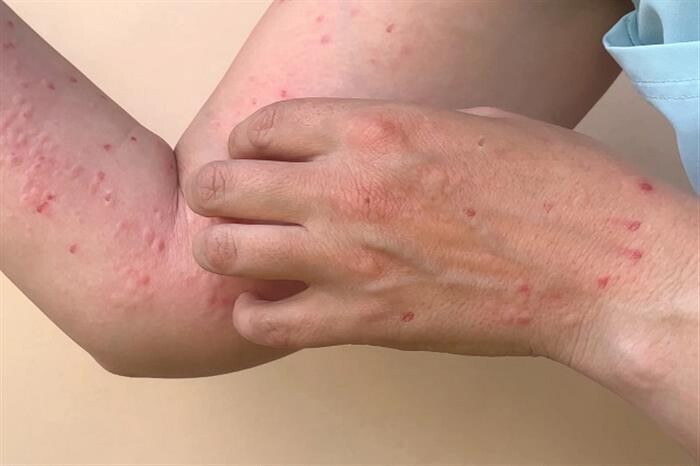 Беспокойство растет из-за нового варианта оспы обезьян в Сингапуре